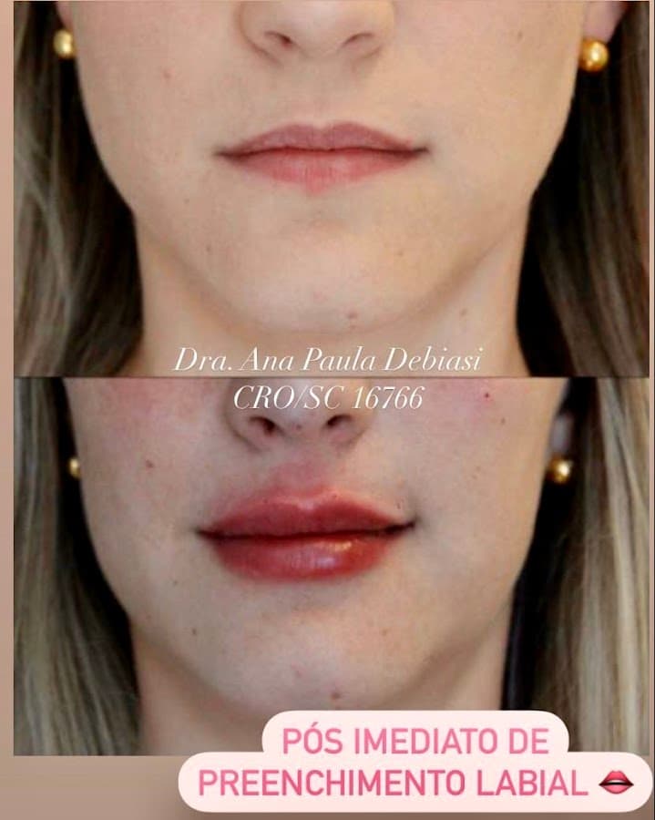 Depois — Resultado real